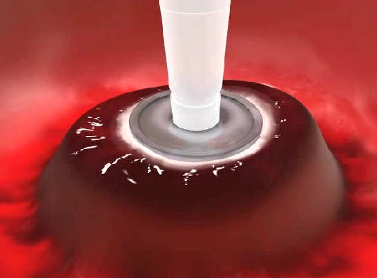 冷凍外科裝置(冷凍治療儀)工作效果圖 冷凍外科裝置(冷凍治療儀)工作效果圖